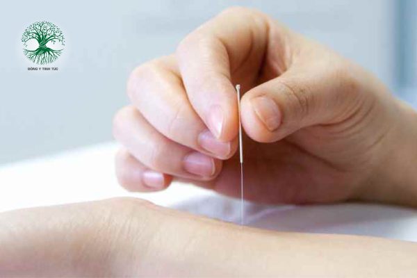 Phương Pháp Châm Cứu Chữa Mất Ngủ Theo Y Học Cổ Truyền 4 cham cuu chua mat ngu 02